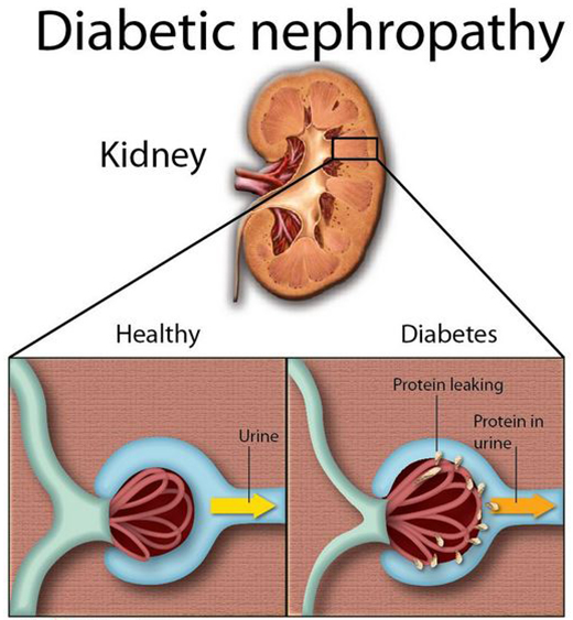 diabetic nephropathy