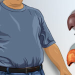REMISSION OF TYPE 2 DIABETES REQUIRES DECREASE IN LIVER FAT