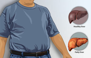 Man with fatty liver
