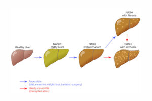 NAFLD and NASH